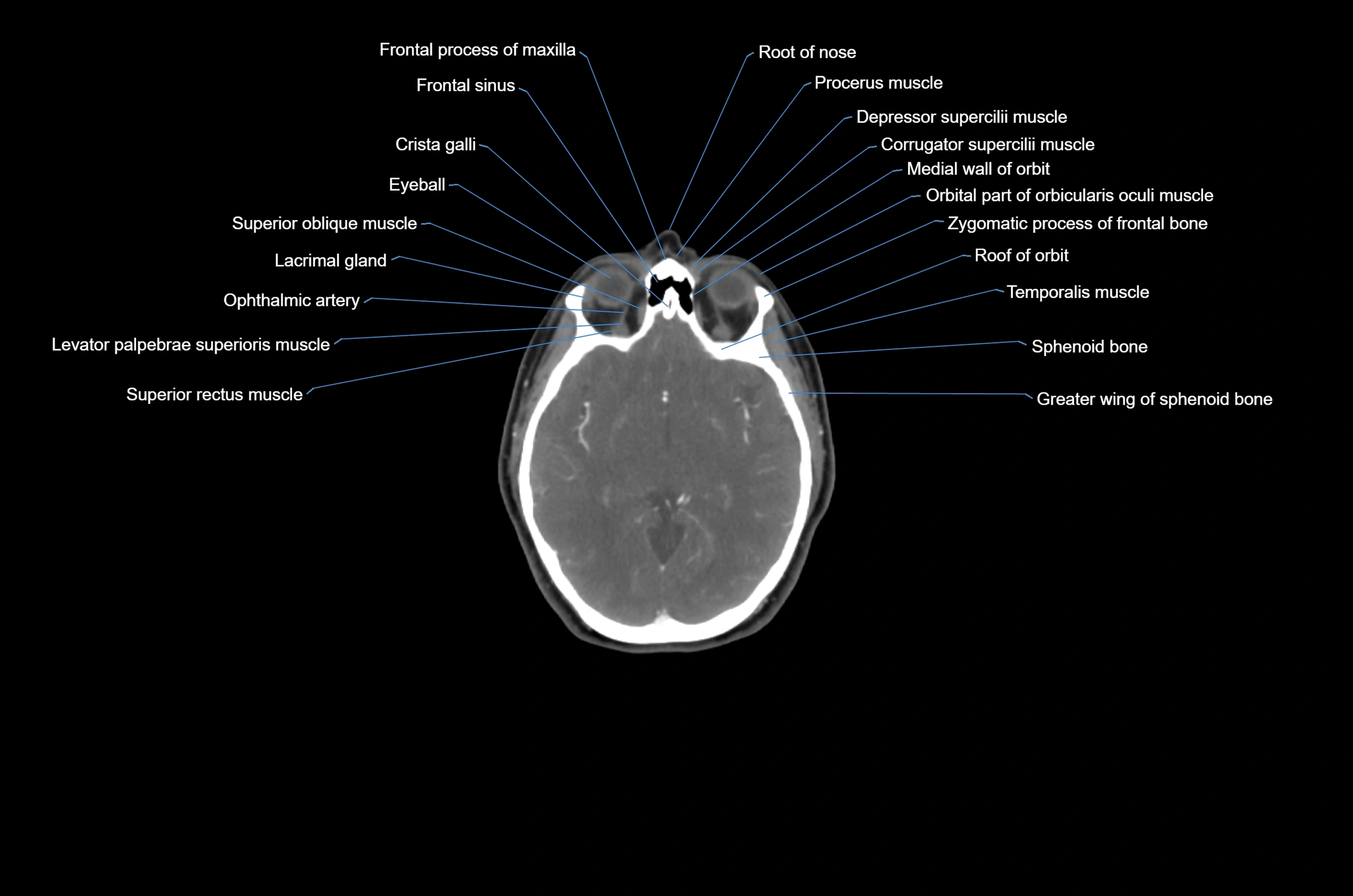 CT Neck axial cross sectional anatomy radiology image-img-00001-00003.webp